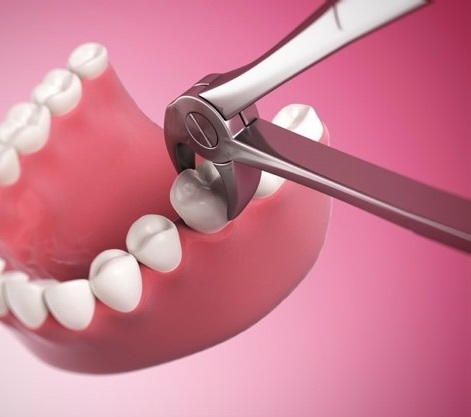 Gentle Extractions and Dental Fillings