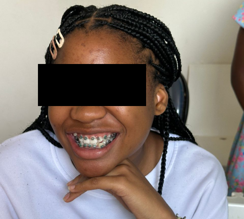 Klarity medical dental braces